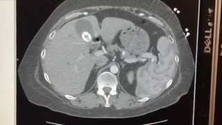 Cholelithiasis on CT scan [upl. by Ayaros]