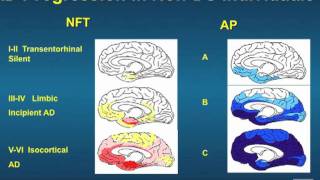 Dr Linda Ercoli quotNeuroimaging in Down syndromequot [upl. by Ynafetse]