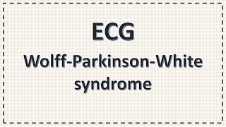 WPW syndrome  ECG  Wolff Parkinson White Syndrome ECG changes simplified  Delta Wave [upl. by Aleacim494]