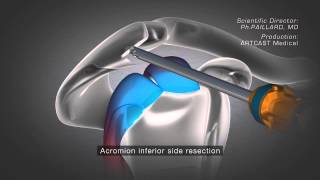 Shoulder Arthroscopy  Acromioplasty [upl. by Alenson313]