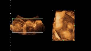 Omphalocele by 4D ultrasound [upl. by Anivahs]