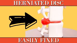 Herniated Disc Clearly Explained amp Easily Fixed [upl. by Aholah]