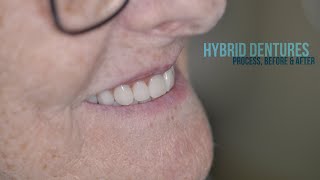 Hybrid DENTURES Process Before and After dentures smile dentistry painting teeth [upl. by Dust246]