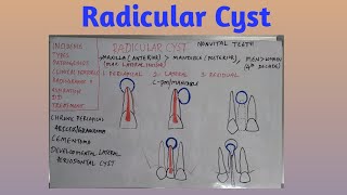 Radicular cyst [upl. by Airogerg]