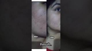 Mistine Acne clear Facial foam review shorts review 1week challenge [upl. by Grimaldi651]