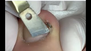 How to remove sharp nail piece [upl. by Oisacin166]