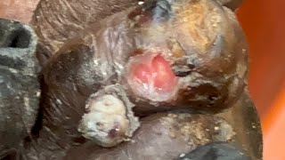 Jackson’s left foot  fat whole jiggers pulled out  see full video by subscribing net [upl. by Otrebor]