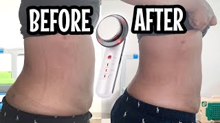 Ultrasonic Fat Cavitation Before And After  Fat Cavitation Before And After Results  AMAZING [upl. by Tymothy162]