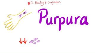 Pupura  Bleeding Disorders [upl. by Tsyhtema774]