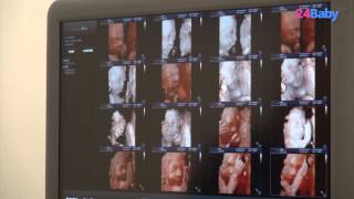 Pretecho Een 3D en 4D echo  24BabyTV [upl. by Gosser]