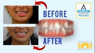 Invisalign Before and After Crowded Teeth [upl. by Tris]