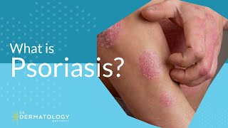 What Is Psoriasis [upl. by Alih196]