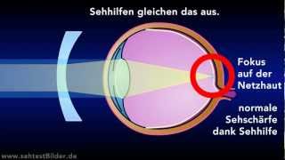 Was ist Kurzsichtigkeit kurzsichtig sehen [upl. by Puff]