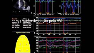 Marca passo ou sem marca passo [upl. by Lancaster]