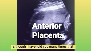 Anterior placenta baby gender  12 weeks Twin pregnancy  3 vessel cord or turtle sign  ultrasound [upl. by Nickie]