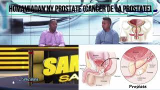 HOMAMIADANNY PROSTATE CANCER DE LA PROSTATE MG [upl. by Okajima]