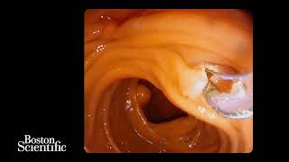 ERCP in pancreas divisum using the Exalt singleuse duodenoscope [upl. by Daniala]