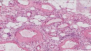 Angiomyolipoma  Kidney Histopathology [upl. by Annaeirb]