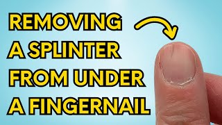 My Simple Trick to Instantly Remove a Splinter From Under Your Fingernail watch until the end [upl. by Giah]