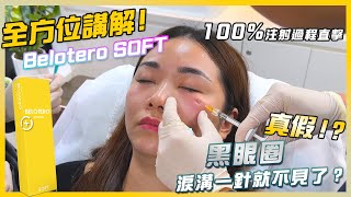 Belotero SOFT 透明質酸彩虹針｜想改善眼周黑眼圈要靠佢？ 淚溝又可以嗎？｜即時有效果？與其他透明質酸膠原蛋白針劑又有什麼分別？｜素人直擊 全方位講解！ medskinHK [upl. by Enirroc653]