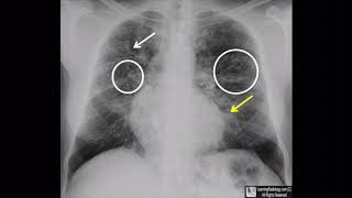 Cystic Fibrosis [upl. by Behlke]