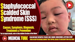 Staphylococcal Scalded Skin Syndrome SSS  Causes Symptoms Treatment  Lancet Infectious Diseases [upl. by Shaffer]