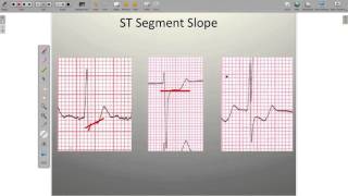 Effects of Ischemia on the ECG [upl. by Menedez425]