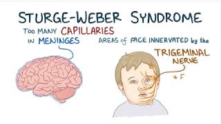 sturgeweber syndrome [upl. by Shah]