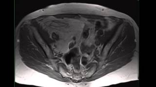 Retroperitoneal liposarcoma [upl. by Ulda510]