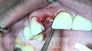 Atraumatic Extraction Socket preservation and temporization  Alvaro Ordoñez DDS [upl. by Annotahs]