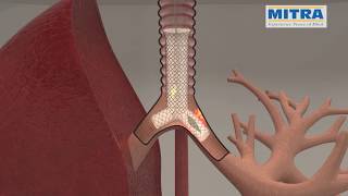 Tracheobronchial quotYquot stent MITRA OTTOMED ENDOSCOPY Interventional Pulmonology [upl. by Corney]