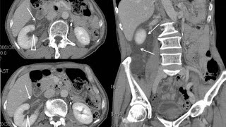 Moderate obstructive uropathy region due to renal calculus  cect abdomen and pelvis [upl. by Slyke]