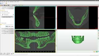 Create the nerve and segment the 3D model step3 [upl. by Litnahc]