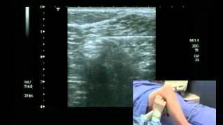 Popliteal Block Ultrasound guided  lateral approach [upl. by Ohs27]