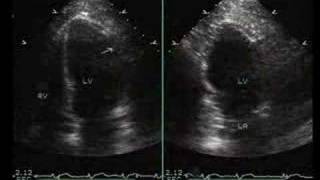 InferiorPosterior and Lateral Myocardial Infarction [upl. by Nadruoj]