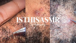 ASMR INGROWN REMOVAL PT 6  INSIDE THE BEARD [upl. by Isolda]