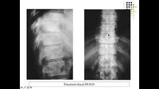 LA SPONDYLODISCITE TUBERCULEUSE ET NON TUBERCULEUSE [upl. by Llerrud]