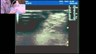 Ultrasound guided ankle block part 2 Supdeep peronealfibular nerves and saphenous nerve [upl. by Eisteb]