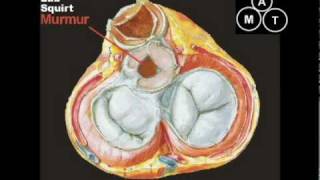 Animated Aortic Stenosis Murmur [upl. by Enuj985]