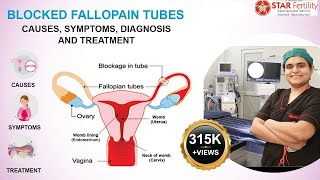 Tubal Block Symptoms Blocked fallopian tubes treatment Test Blockage block tube ko Kaise kholen [upl. by Ube]