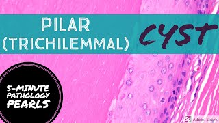 Pilar Trichilemmal Cyst 101 5Minute Pathology Pearls [upl. by Krall326]