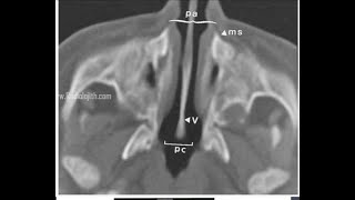 POSTERIOR CHOANAL ATRESIA VERSUS CONGENITAL APERTURE STENOSIS IN CT PNS OF TWO NEWBORN BABIES [upl. by Friedlander]