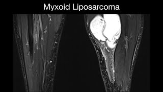 Myxoid Liposarcoma [upl. by Dyun150]