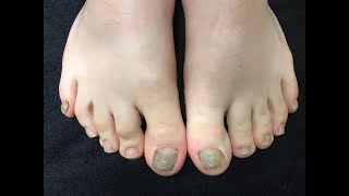 Using Laser to Treat Fungal Nails with pictures [upl. by Budding]