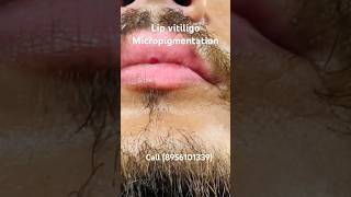 Lip vitiligo micropigmentation  vitiligo lip tattoo coverup vitiligo lip camouflage vitiligocures [upl. by Priest]