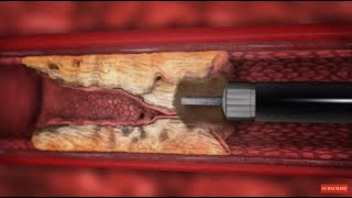 TurboElite laser atherectomy animation [upl. by Ahsiryt75]