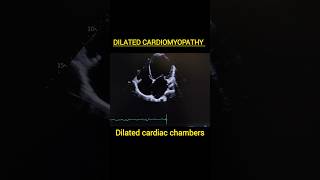 Dilated Cardiomyopathycardiomyopathymyocarditisechoheartfailure heartfunctionpericarditis [upl. by Eisnyl]