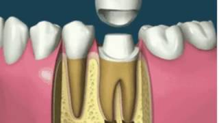 Dental Crown with Root Canal Treatment [upl. by Nahta]