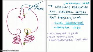 Easy Ways to Remember Cerebral Herniation [upl. by Dietsche]