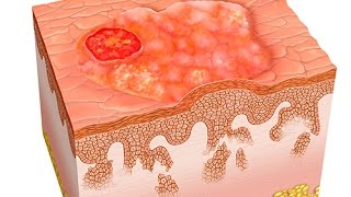 Le dépistage du cancer du sein [upl. by Kcin]